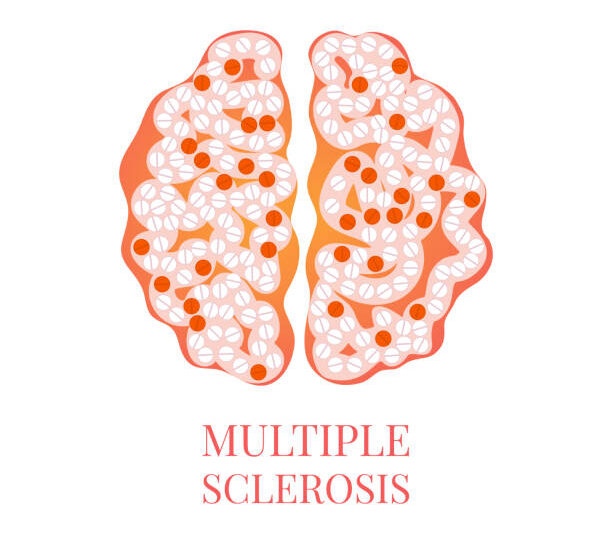 Understanding Multiple Sclerosis: A Guide to Causes, Symptoms, and Effective Management.
