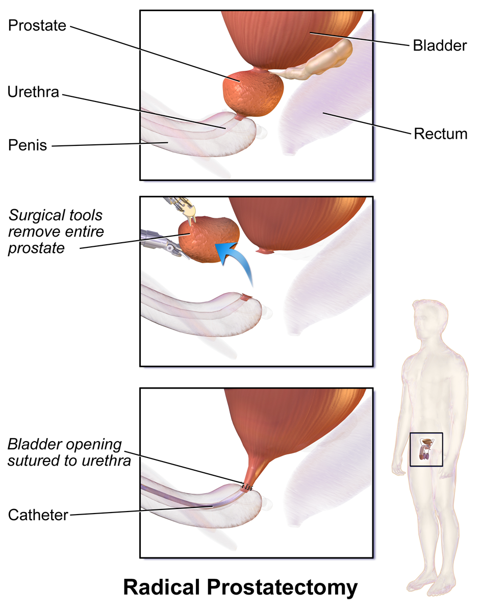 Improve Prostate Health Naturally with Men Balance Pro.