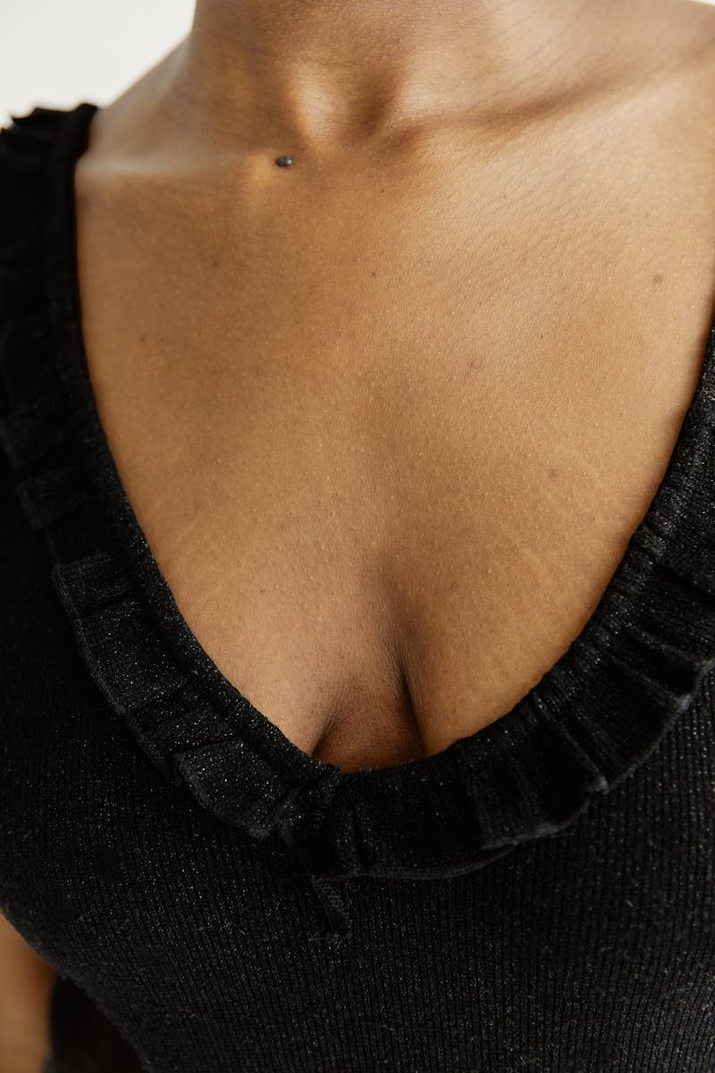 Solution to Stretch Marks: .