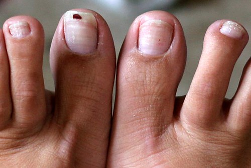 KeraBiotics: The Natural Way to Treat Nail Fungus.