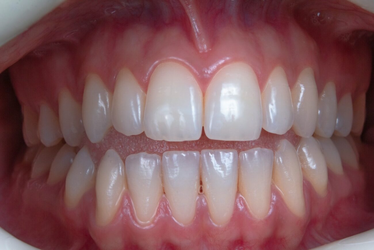a person's mouth with teeth